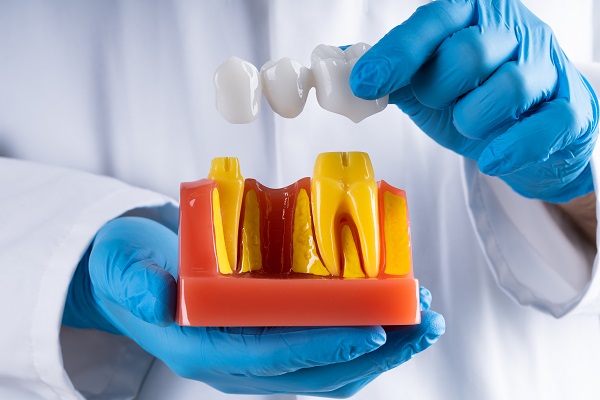 Popular Dental Bridge Solutions