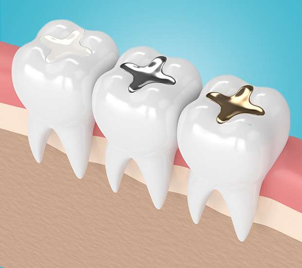 Austin Composite Fillings