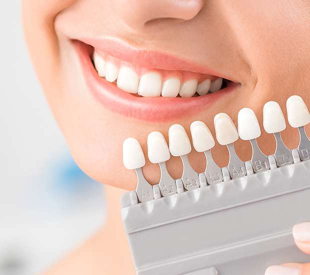 Austin Dental Veneers and Dental Laminates