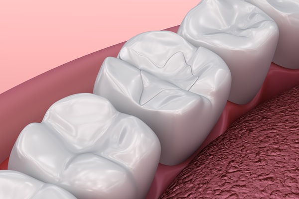 How Tooth Colored Fillings Can Restore Your Smile