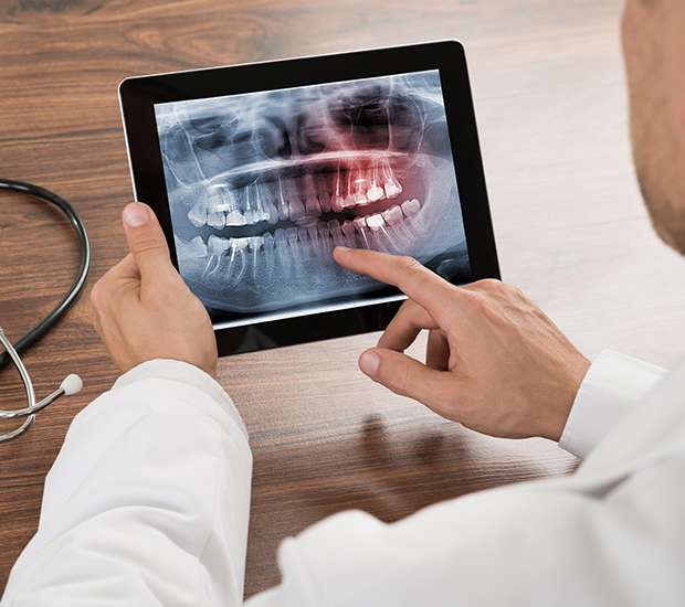 Austin Types of Dental Root Fractures